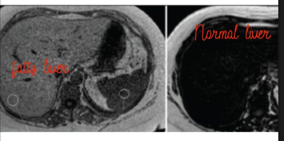 Fatty Liver Disease-Is It Fatal ? IMG 20240215 202215